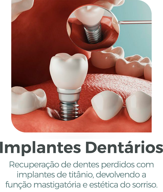 implantes
